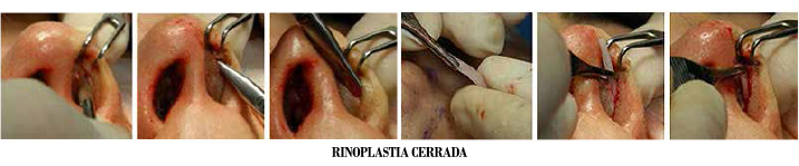 rinoplastia cerrada