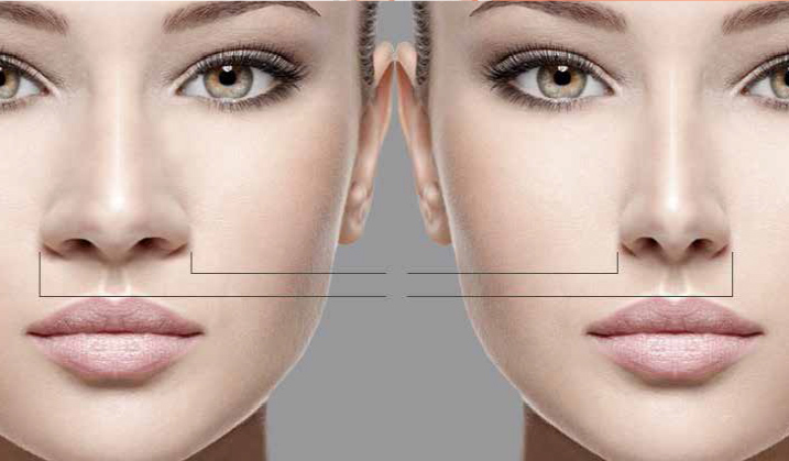 rinoplastia